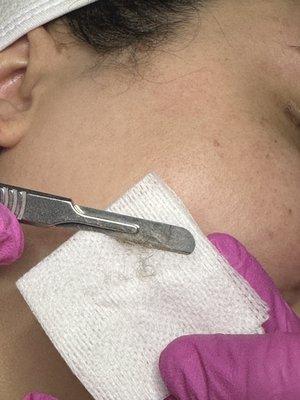 Dermaplaning facial