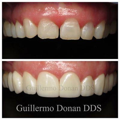 Cosmetic Dentistry and Dental Veneers can restore and beatify your smile, call us to set up a dental consultation at 559 2229923