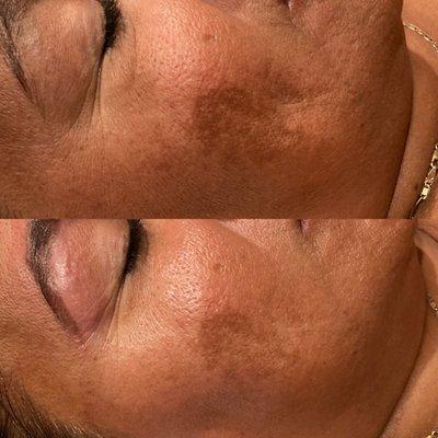 Dermaplaning to remove years of sun damage and dehydration.