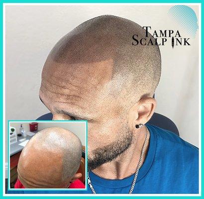 Second session of Scalp Micropigmentation for this customer.