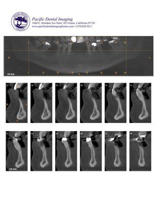 Implant Scan