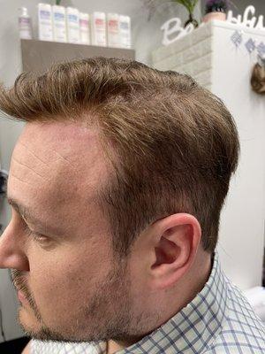 After mens hair system bonded.