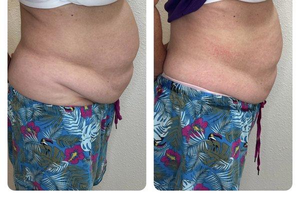 Only 4 sessions with cavitation.