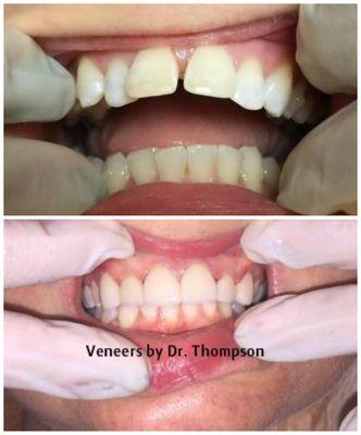 Affordable veneers are possible if you have the right dentist.  High quality of material and high skill level of the dentist is a must.