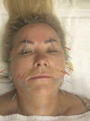 Cosmetic acupuncture and aromatherapy supporting construction.