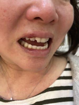 My mouth trauma (plus some tears! )