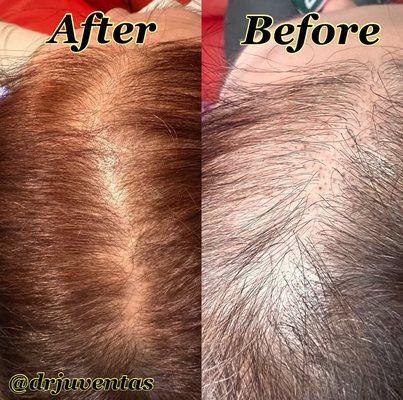 Needle-Free, Pain-Free Hair Restoration Treatment With No Local Anesthesia Needed. ALMA TED is a revolutionary, no