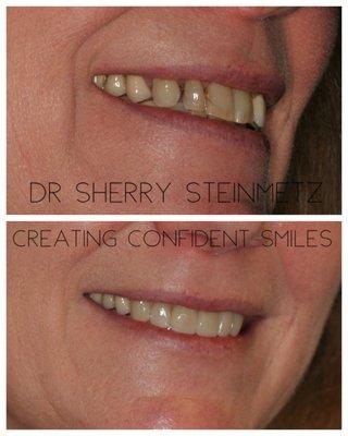 Before and after porcelain veneers by Dr. Sherry Steinmetz. Not everyone wants the whitest :-)