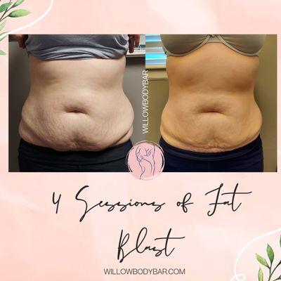 Non-Surgical Lipo - Fat Blast Treatment