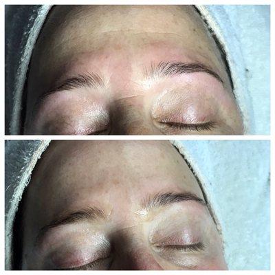 Before and After Wrinkle Reduction Treatment