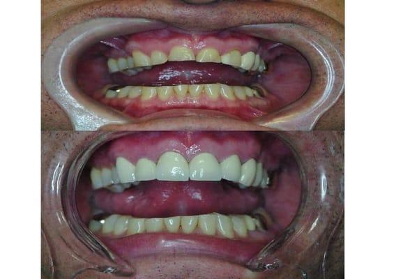 Severely worn teeth restored with porcelain crowns.