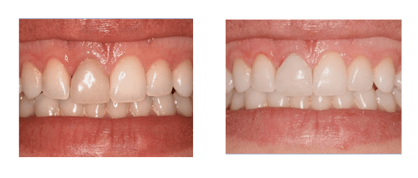 The crown was removed, the dark tooth underneath was bleached and a new esthetic ceramic crown which now matched the other te...