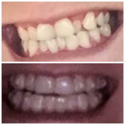 A forever thank you to Dr Finn for helping get a beautiful smile! The posted picture below is a one year process of Invisalign's!