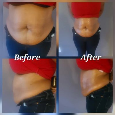 Non-Invasive Lipo Cavitation Treatment