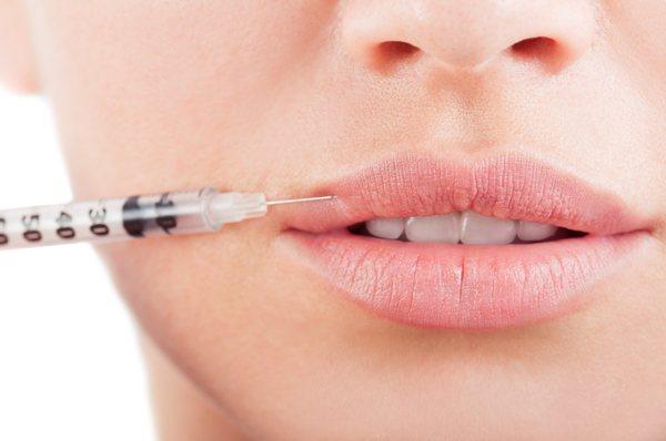 Juvederm Ultra XC - Dermal Filler Lip Augmentation