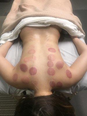 Needles and cupping