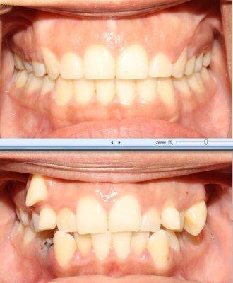 Before and after braces treatment.