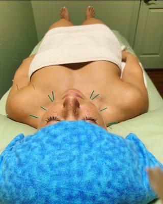 Facial Rejuvenation Acupuncture