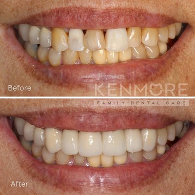 Smile makeover through veneers and crowns to improve your smile!