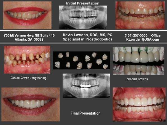 Aesthetic Crown Lengthening & Crowns