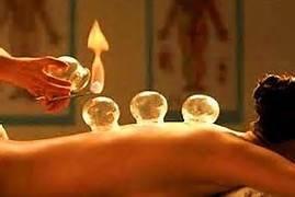 Fire cupping is a therapy that Dr. McCormick provides in his practice to treat a variety of conditions including pain.