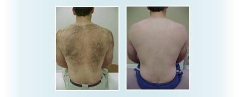 Laser Hair Removal Before & After 6 treatments on the back.