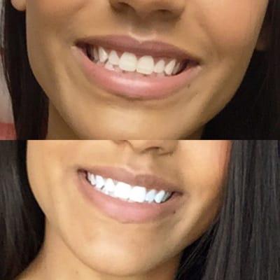 Before and after Dr. Naierman bleached my teeth.