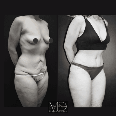 Tummy tuck and fat grafting to breasts before and after