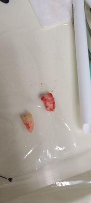 My wisdom teeth