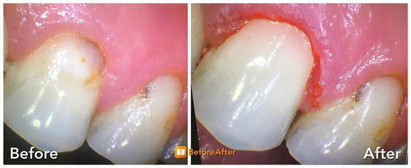 We treat cavities with excellent matching white fillings .Dr Mina Abdullah