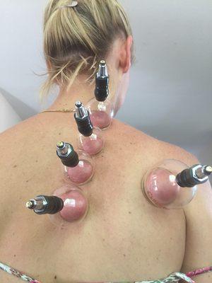 Cupping