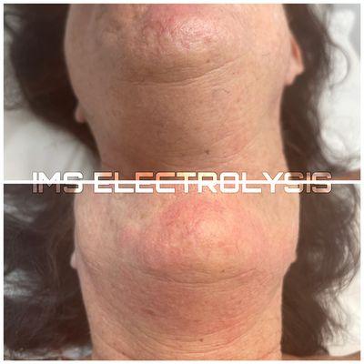 Electrolysis hair removal