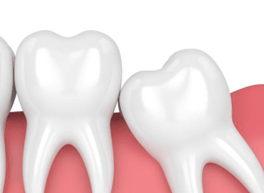 Tooth extraction may be necessary if a tooth has severe decay, periodontal disease, irreparable damaged, or is impacted...