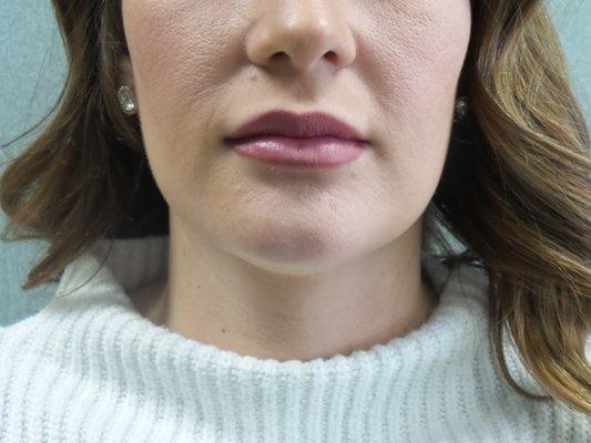 Lips after Volbella lip filler