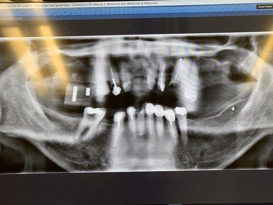 X rays taken at team dental over 20k of work all done by them