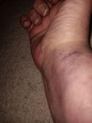 More  bruising