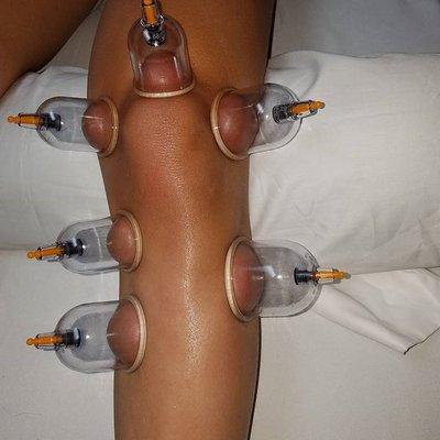 Cupping to promote circulation on this soccer player's knee.