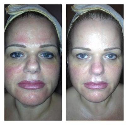 Before and After 1 Microcurrent Facial