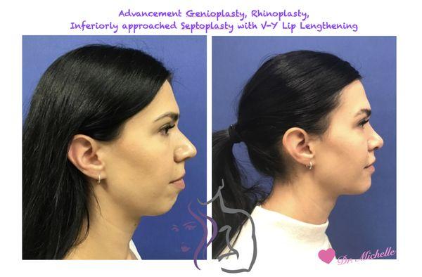 Advancement Genioplasty, rhinoplasty, septoplasty done by Dr. Michelle Cabret