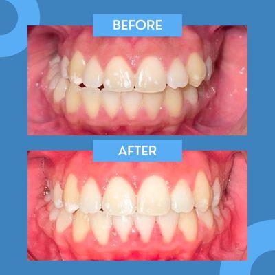 Before and after Fast Braces