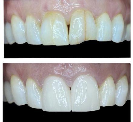 Before and After 2 front crowns