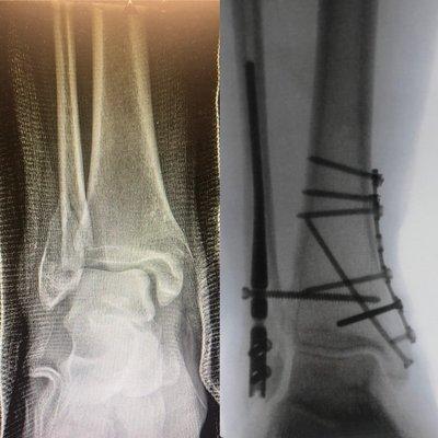 Ankle fracture