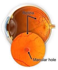 Macular Hole