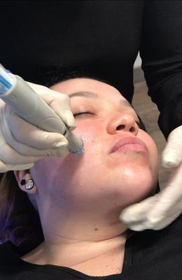 HydraFacial treatment