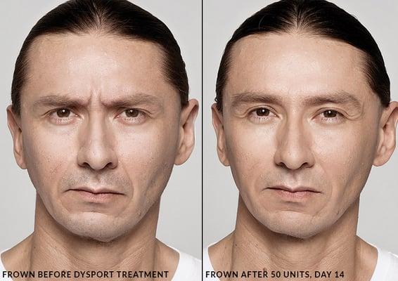 This patient received treatment for wrinkles with Dysport®.