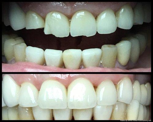 Broken veneers replacement