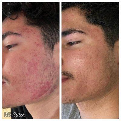 Acne treatment with Keloid Scar Removal