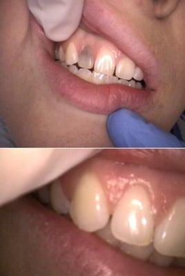 Before and after of internal bleaching