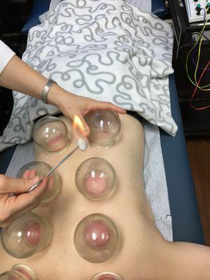 Fire Cupping  can help to detox your body, release muscle pain .