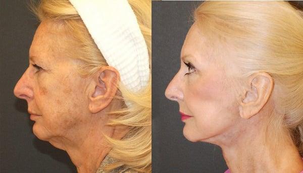 Neck Lift Surgery